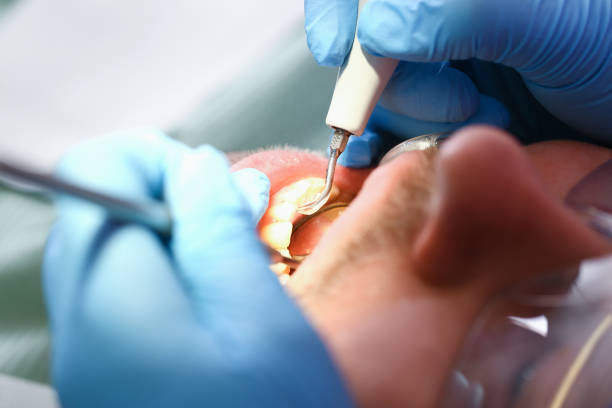 Best Emergency Treatment for Dental Infections or Abscesses in Teague, TX