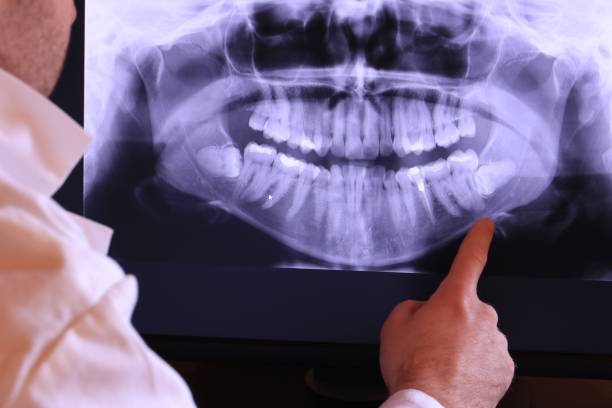 Best Emergency Treatment for Dental Infections or Abscesses in Teague, TX